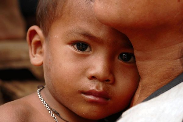 Unterernährtes Kind aus Kambodscha